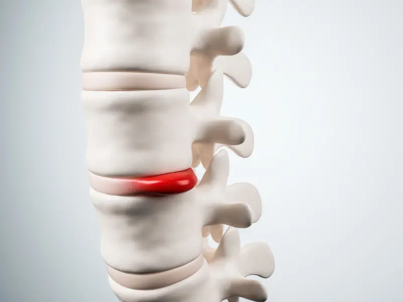 Disc Injury Treatment Near Me in Fort Worth, TX. Chiropractor For Disc Injury Pain Relief.