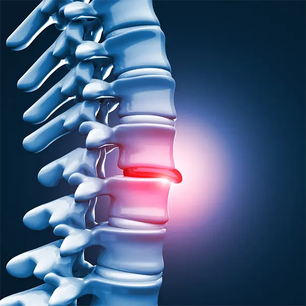 Disc Injury Treatment Near Me in Fort Worth, TX. Chiropractor For Disc Injury Pain Relief.