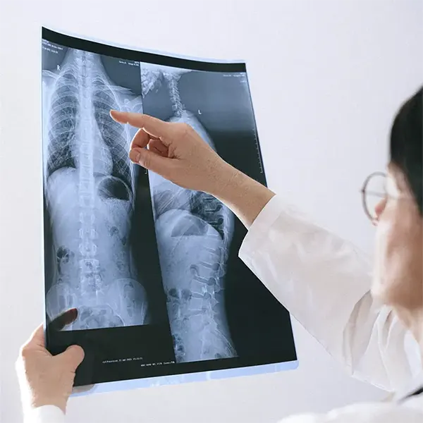 Scoliosis Treatment Near Me in Fort Worth, TX. Chiropractor For Scoliosis Pain Relief.